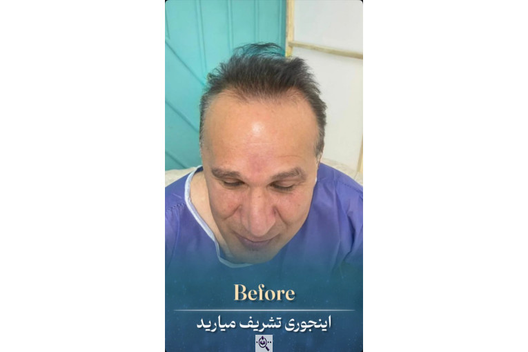 کاشت مو زینب خواجه پور در اهواز