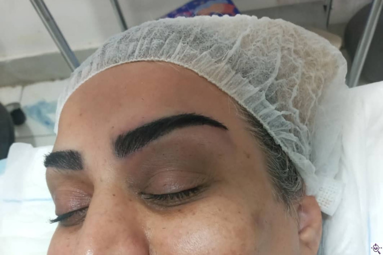 کاشت مو و ابرو آفرینش در پلدختر