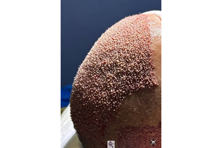 کاشت مو و ابرو آفرینش در پلدختر