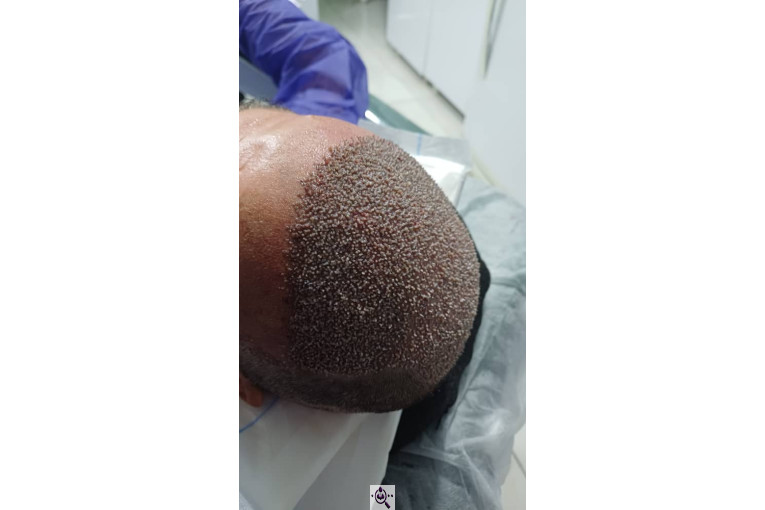 کاشت مو و ابرو آفرینش در پلدختر