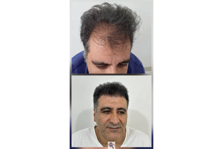 کاشت مو و ابرو آفرینش در پلدختر