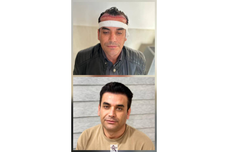 کاشت مو و ابرو آفرینش در پلدختر