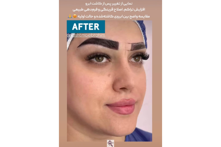 کاشت مو ابراهیم در تهران