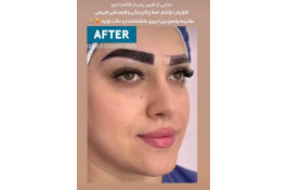 کاشت مو ابراهیم در تهران