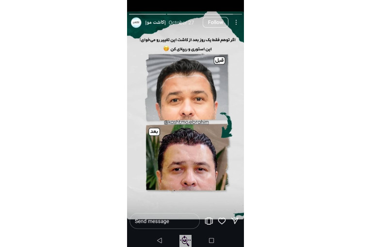 کاشت مو ابراهیم در تهران