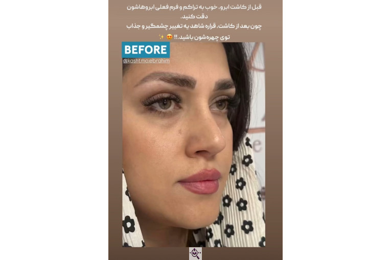 کاشت مو ابراهیم در تهران