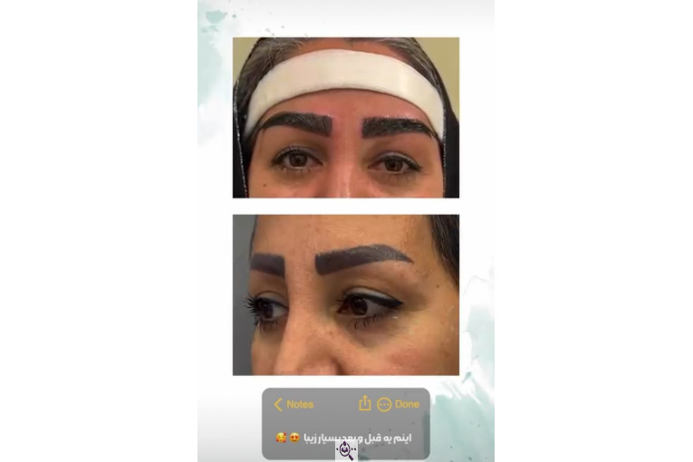 کاشت مو ابراهیم در تهران