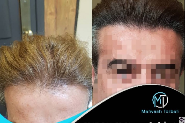 کاشت مو مهوش تربتی در شیراز