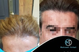 کاشت مو مهوش تربتی در شیراز