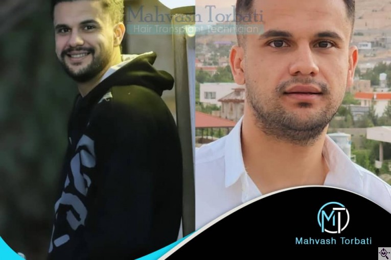 کاشت مو مهوش تربتی در شیراز