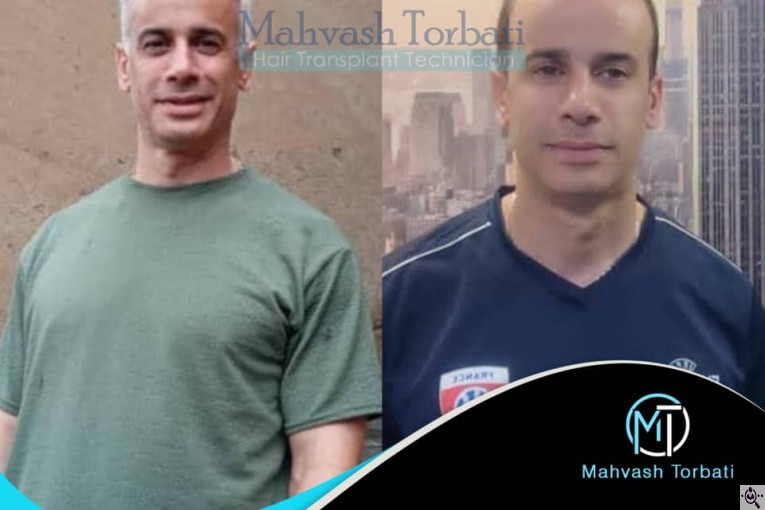 کاشت مو مهوش تربتی در شیراز