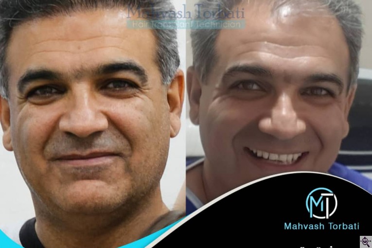 کاشت مو مهوش تربتی در شیراز