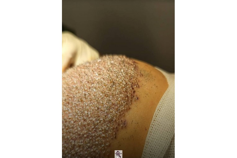 کاشت مو مهوش تربتی در شیراز