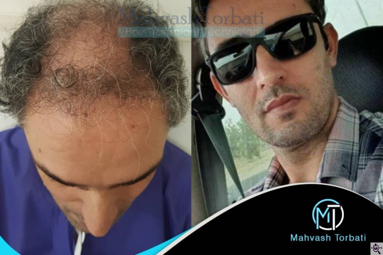 کاشت مو مهوش تربتی در شیراز