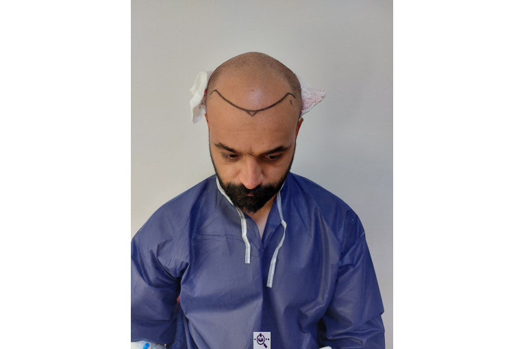 کاشت مو فرشته غلامی در تهران و ایلام