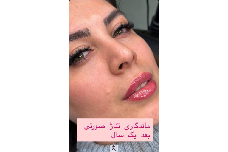 فیبروز و میکروبلدینگ نفیسه قلیچ در تهران