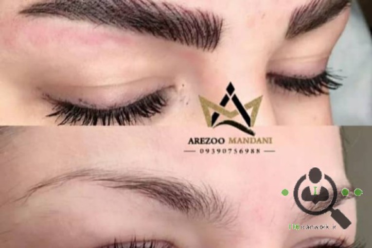 میکرو بلیدینگ آرزو ماندنی در اصفهان