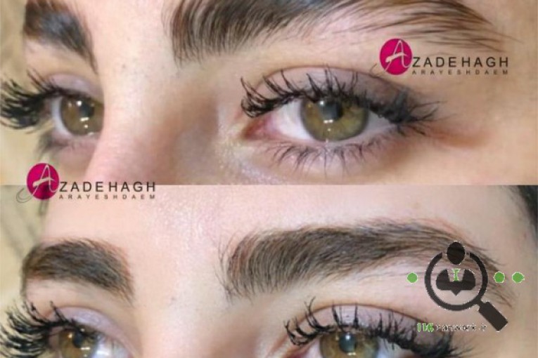 میکروبلیدینگ آزاده در قزوین 