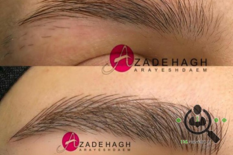 میکروبلیدینگ آزاده در قزوین 