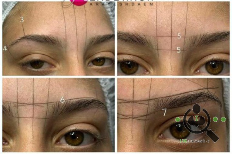 میکروبلیدینگ آزاده در قزوین 
