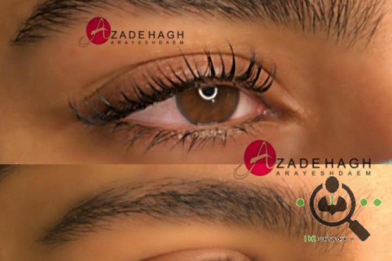 میکروبلیدینگ آزاده در قزوین 