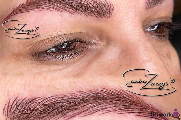 میکروبلیدینگ و فیبروز و تاتو سمیرا زرنگی در پیروزی تهران