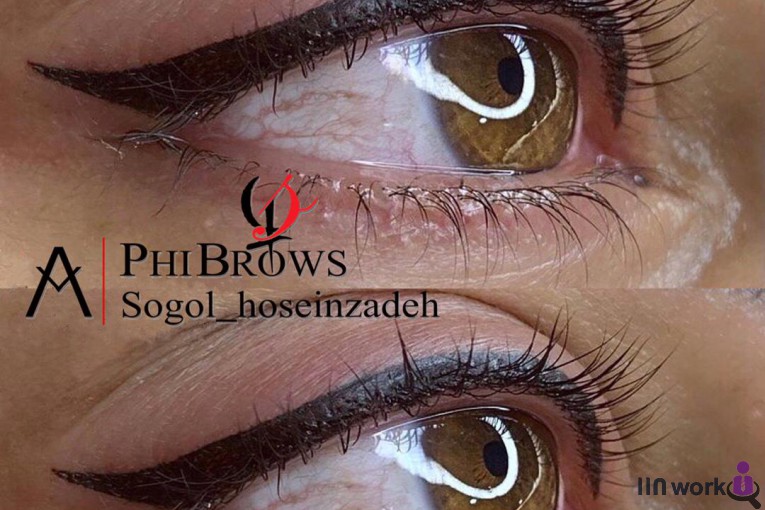 میکروبلیدینگ سوگل در شهریار