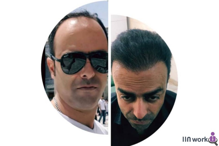 کاشت مو و کاشت ابرو طاهری در تهران