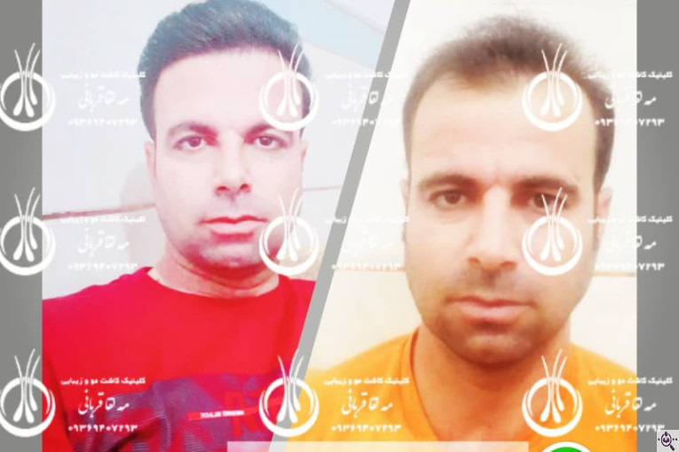 کلینیک کاشت مو دکتر مه لقا قربانی در شیراز