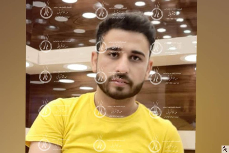 کلینیک کاشت مو دکتر مه لقا قربانی در شیراز