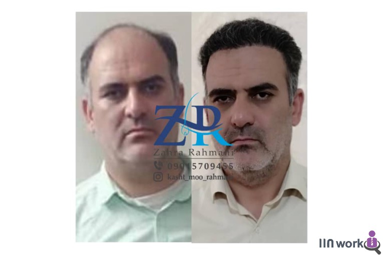 کاشت مو رحمانی در شیراز