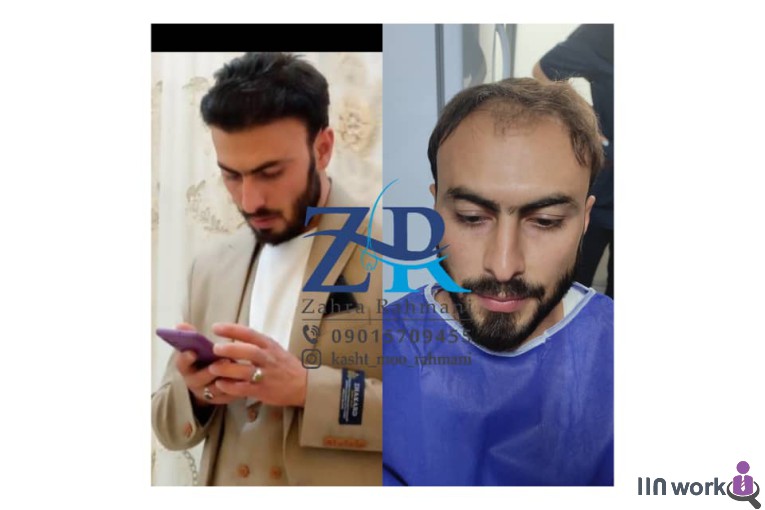 کاشت مو رحمانی در شیراز