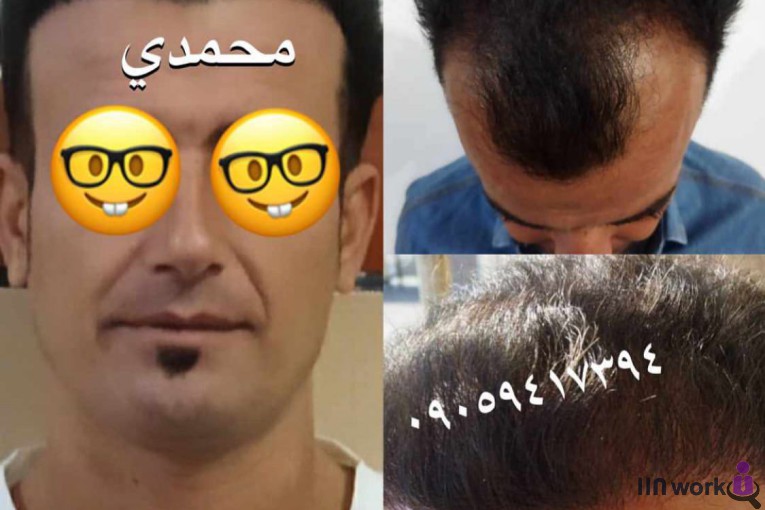 کاشت مو محمدی در شیراز