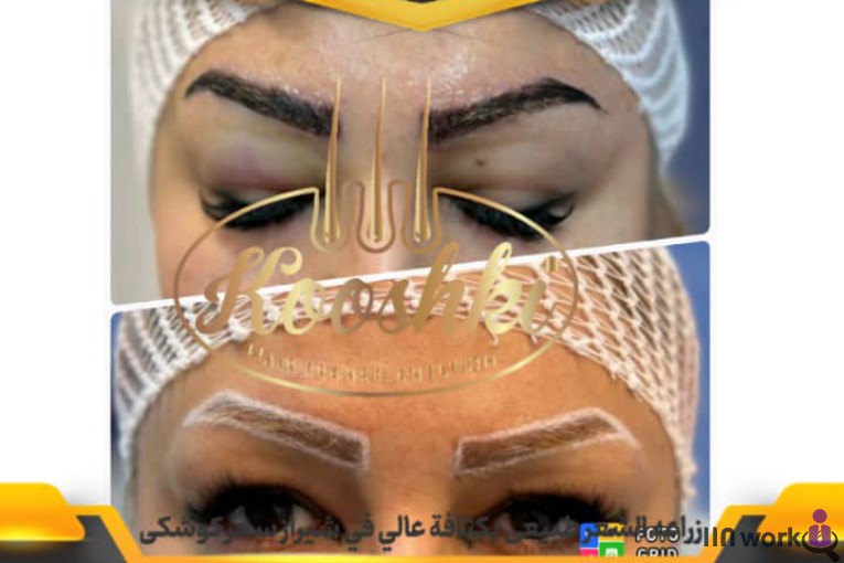 کاشت مو سحر کوشکی در شیراز