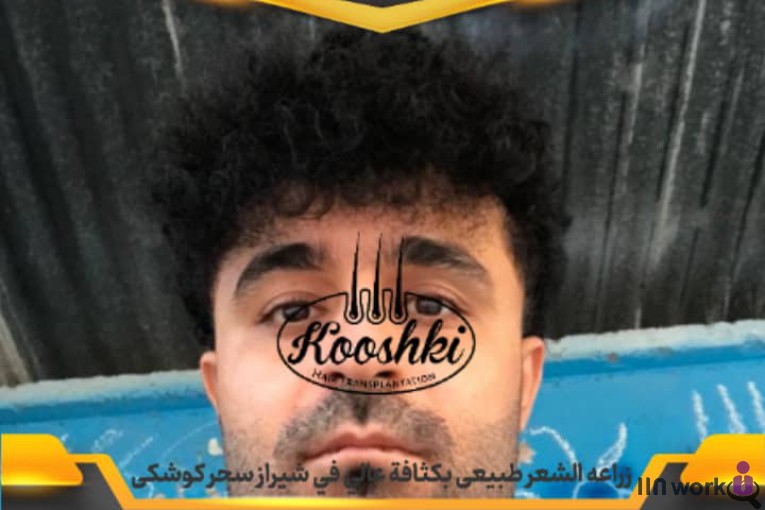کاشت مو سحر کوشکی در شیراز