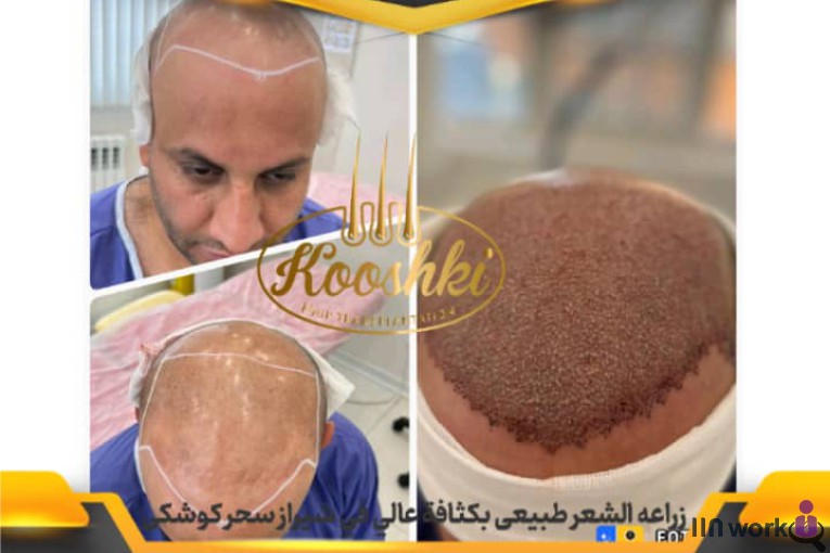 کاشت مو سحر کوشکی در شیراز