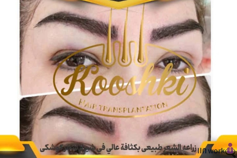 کاشت مو سحر کوشکی در شیراز