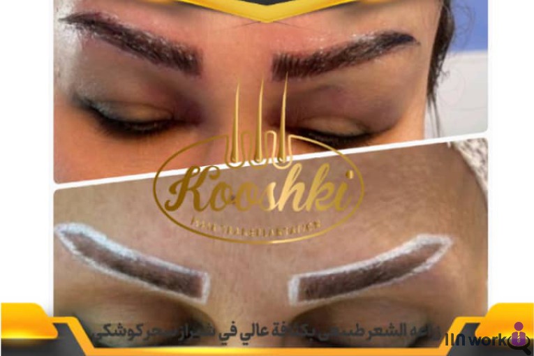 کاشت مو سحر کوشکی در شیراز