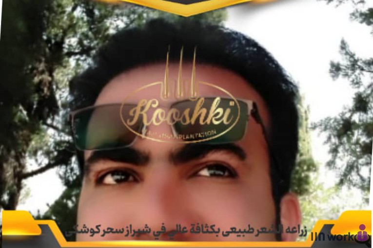کاشت مو سحر کوشکی در شیراز