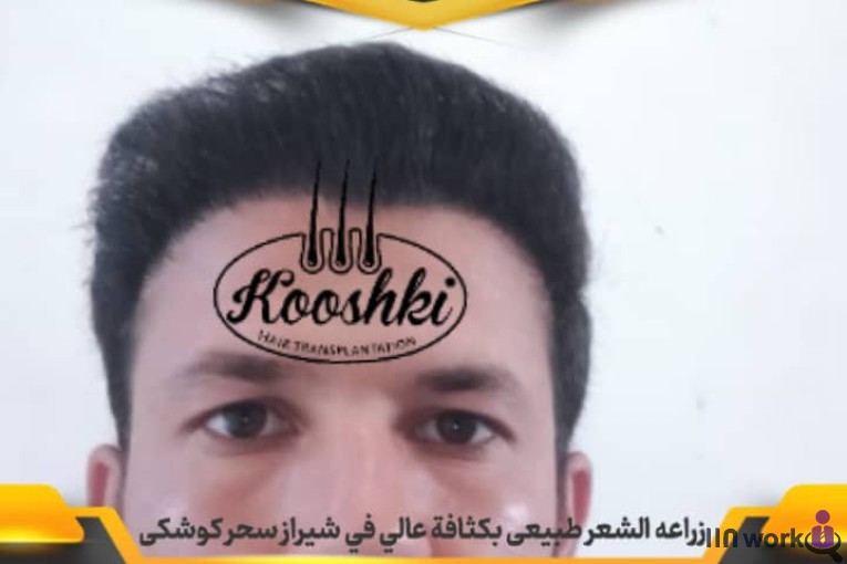 کاشت مو سحر کوشکی در شیراز