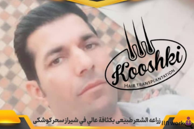 کاشت مو سحر کوشکی در شیراز