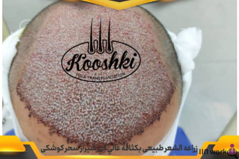 کاشت مو سحر کوشکی در شیراز