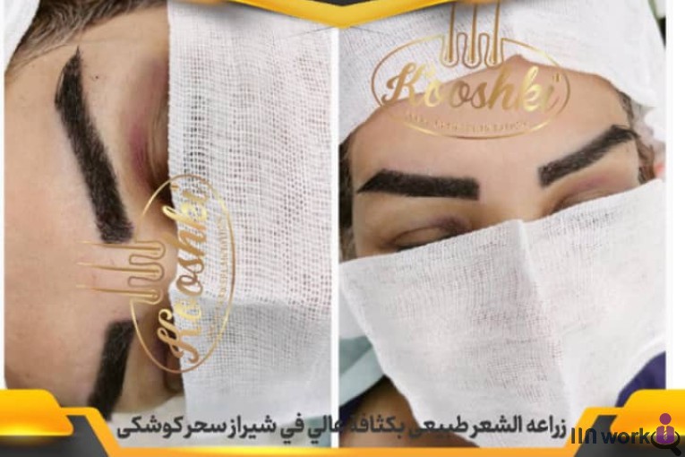 کاشت مو سحر کوشکی در شیراز