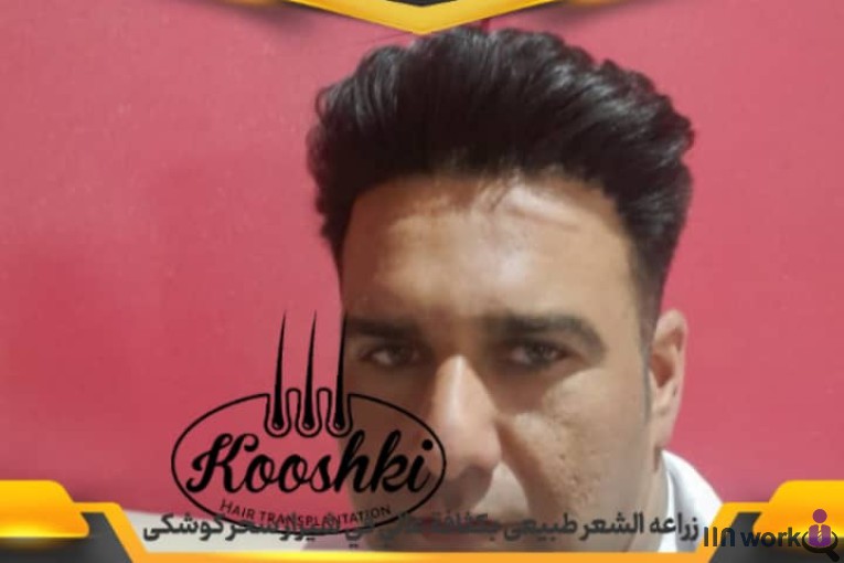 کاشت مو سحر کوشکی در شیراز