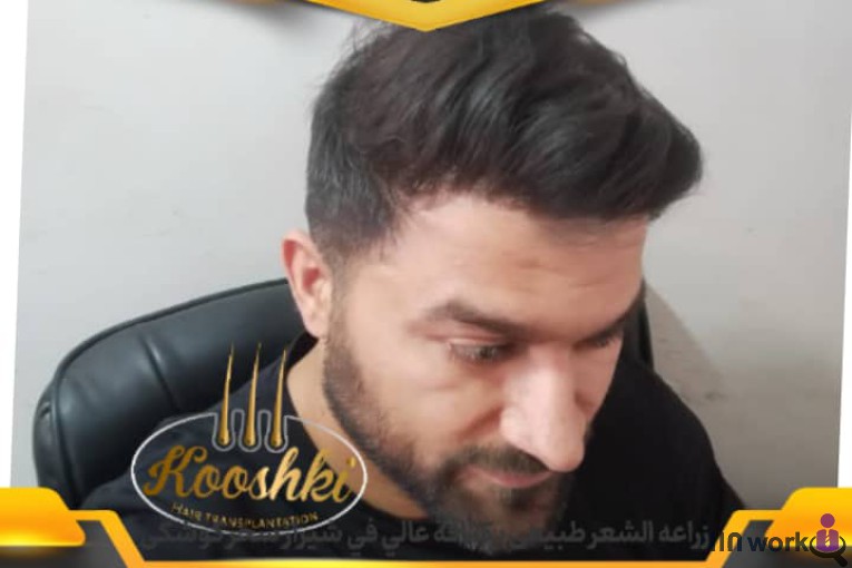 کاشت مو سحر کوشکی در شیراز