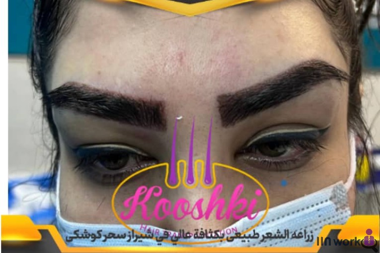 کاشت مو سحر کوشکی در شیراز