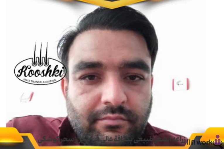 کاشت مو سحر کوشکی در شیراز