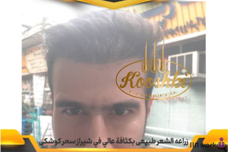 کاشت مو سحر کوشکی در شیراز