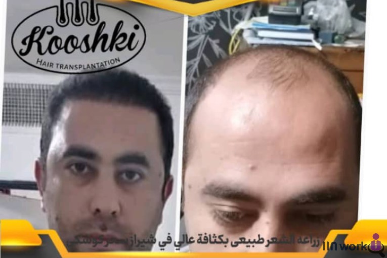 کاشت مو سحر کوشکی در شیراز