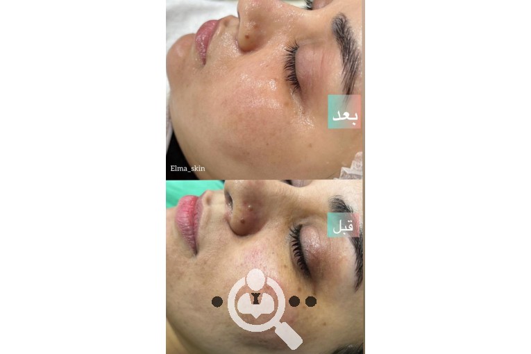 پاکسازی پوست و فیشیال الما کثیر در اهواز